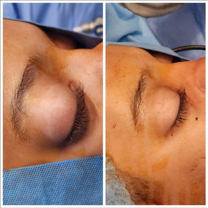 Rare 105gms tumor removed from Teen’s nasal cavity through scarless endoscopic surgery at Medcare Hospital Sharjah